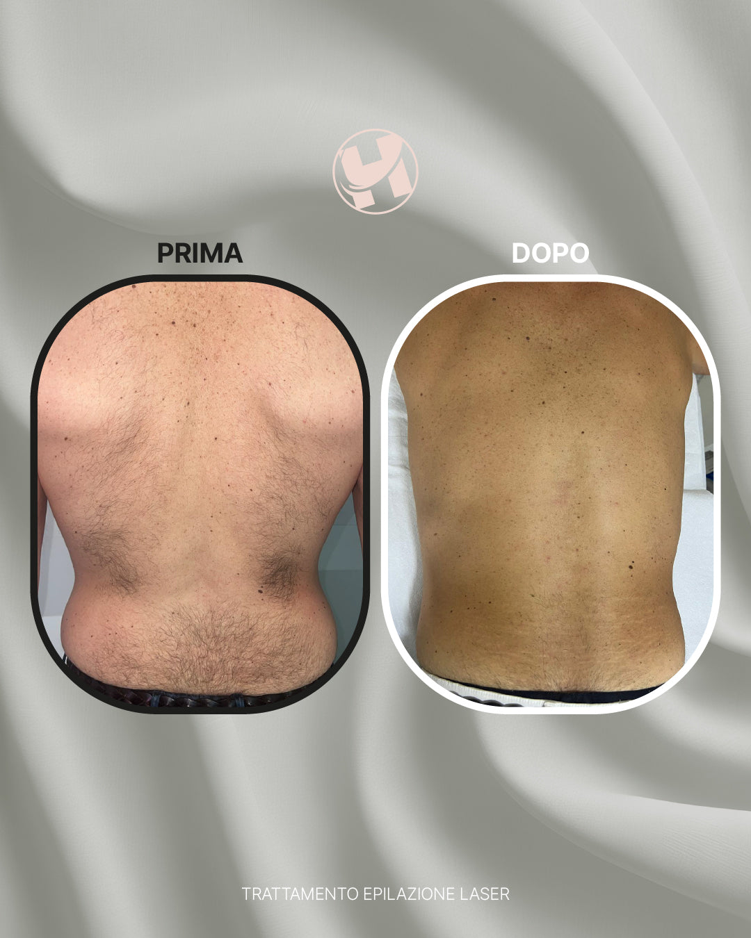 Trattamento di Epilazione Laser Schiena Completa