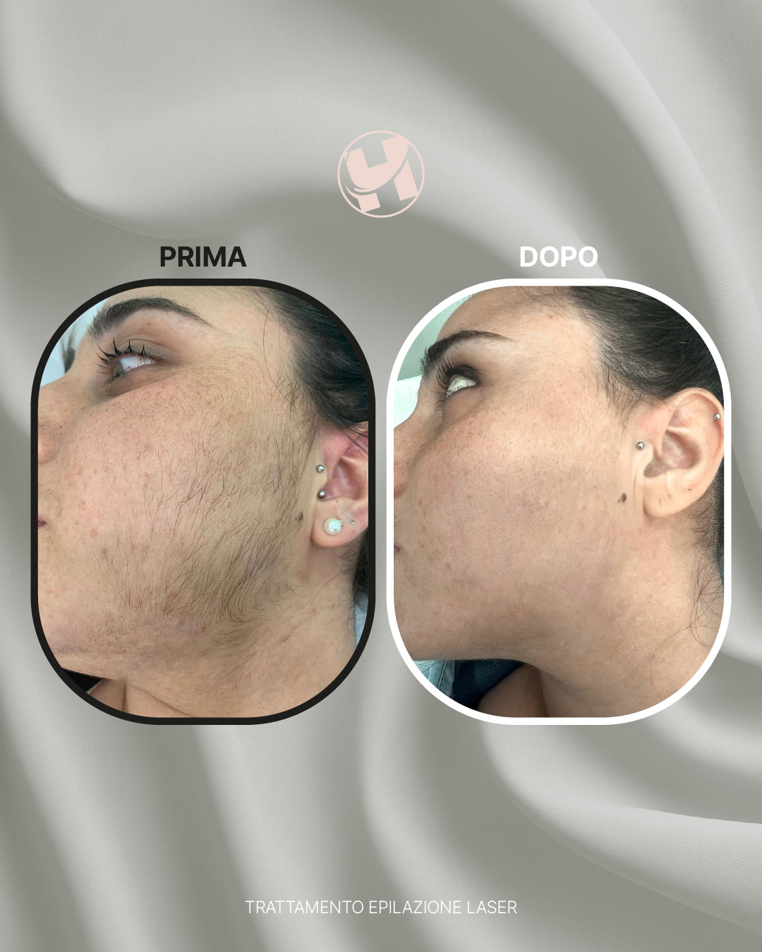 Trattamento di Epilazione Laser Viso