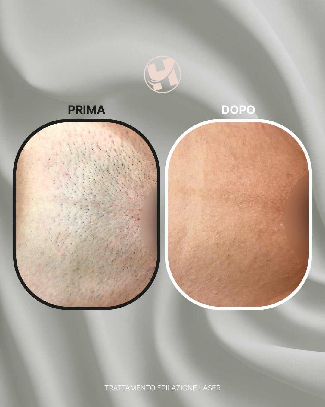 Trattamento di Epilzione Laser Inguine Parziale