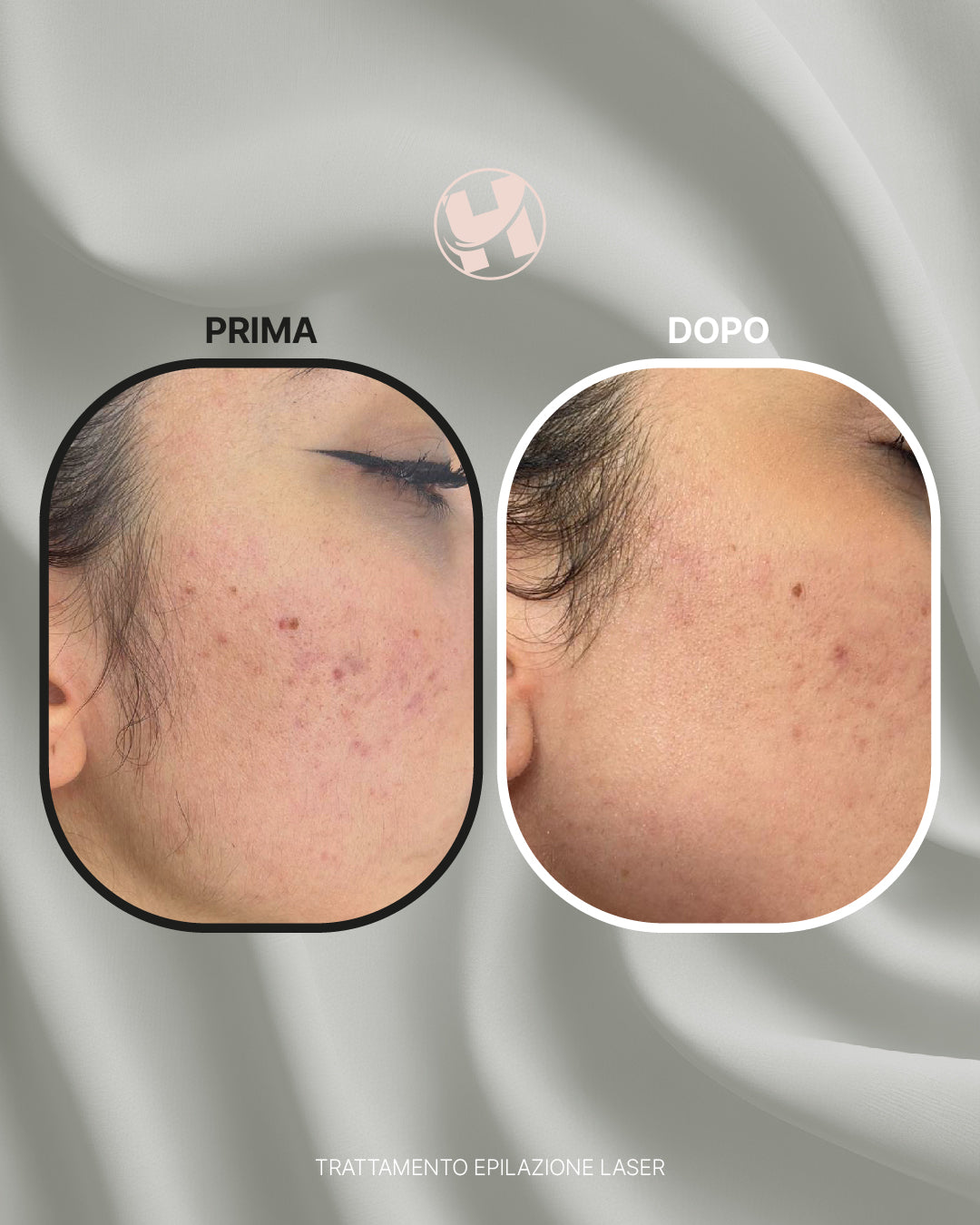 Trattamento di Epilazione Laser Viso