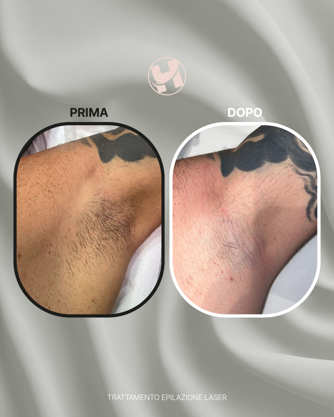 Trattamento di Epilazione Laser Ascella