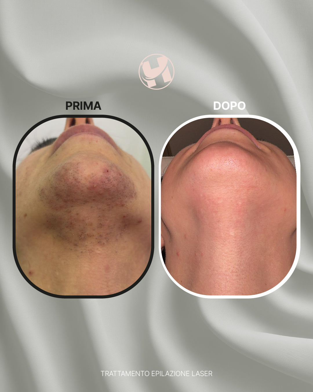 Trattamento di Epilazione Laser Viso