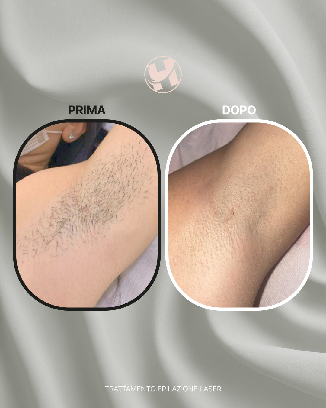 Trattamento di Epilazione Laser Ascella