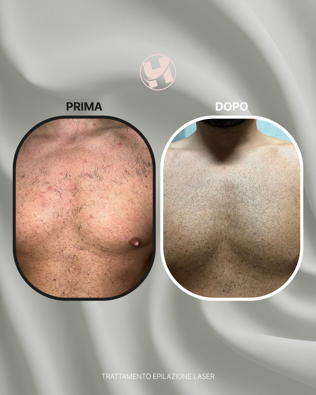 Trattamento di Epilazione Laser Petto