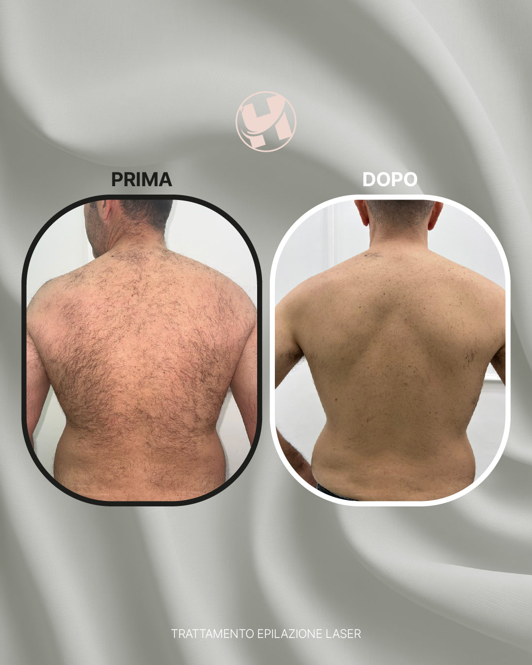 Trattamento di Epilazione Laser Schiena Completa