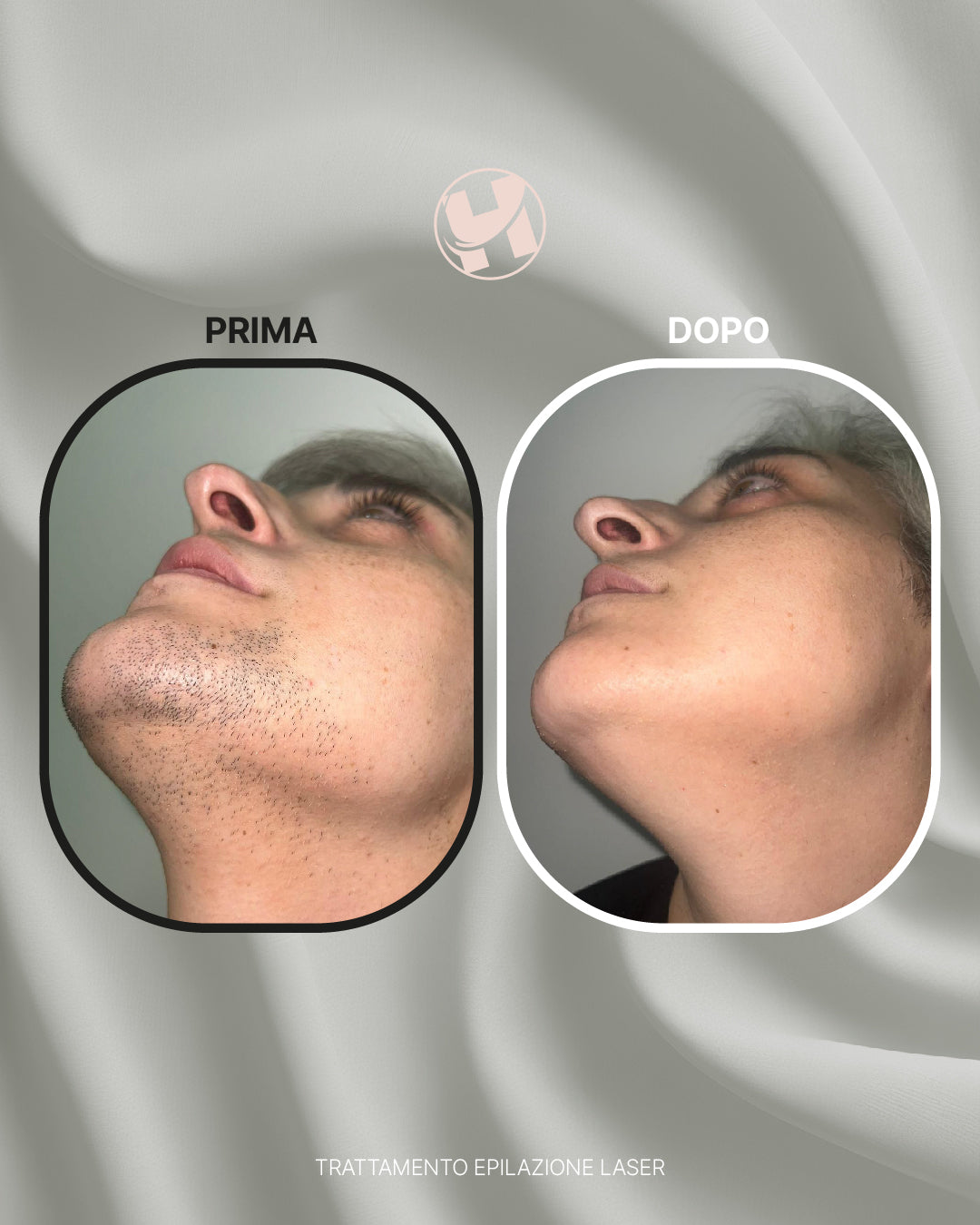 Trattamento di Epilazione Laser Viso